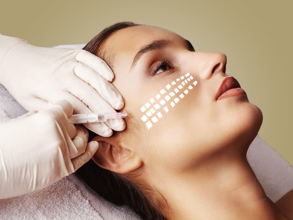 Mezoterapija i biorevitalizacija slide 2